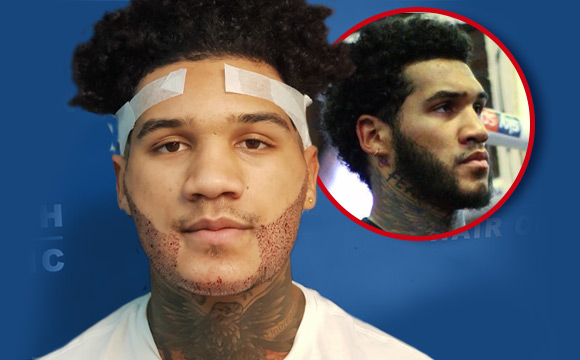 British Hair Clinic - Conor Benn - Main