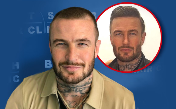 British Hair Clinic - Jamie Gleeson - Main