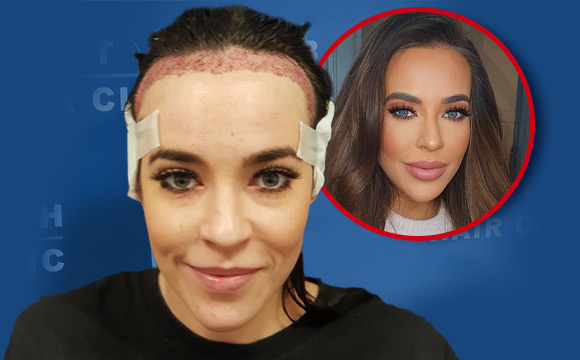 British Hair Clinic - Stephanie Davis - Main