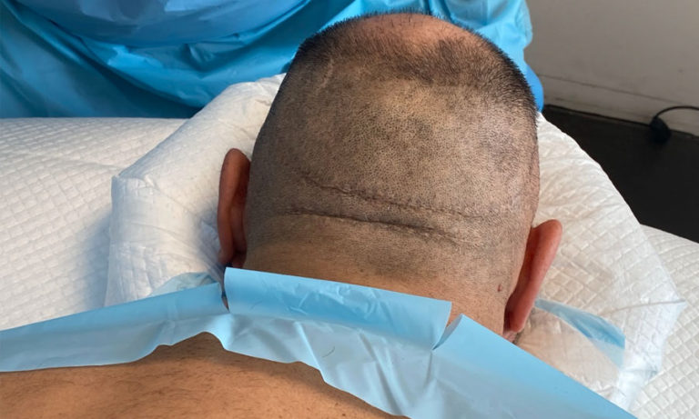 Correcting Hair Transplant Disasters