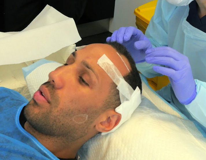 Afro Hair Restoration - Hair Transplant - British Hair Clinic