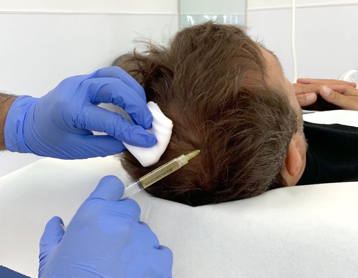 PRP Treatment for Hair Loss - Hair Restoration - British Hair Clinic