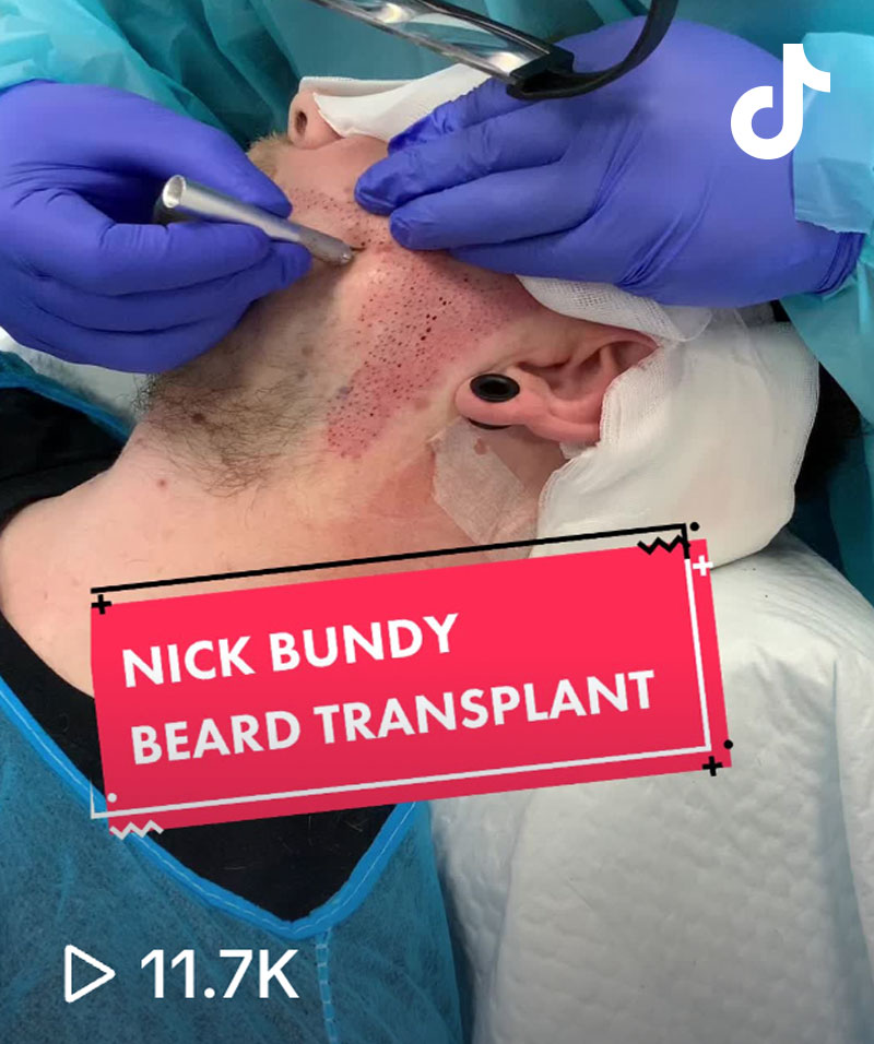 Nicky Bundy - Beard Transplant