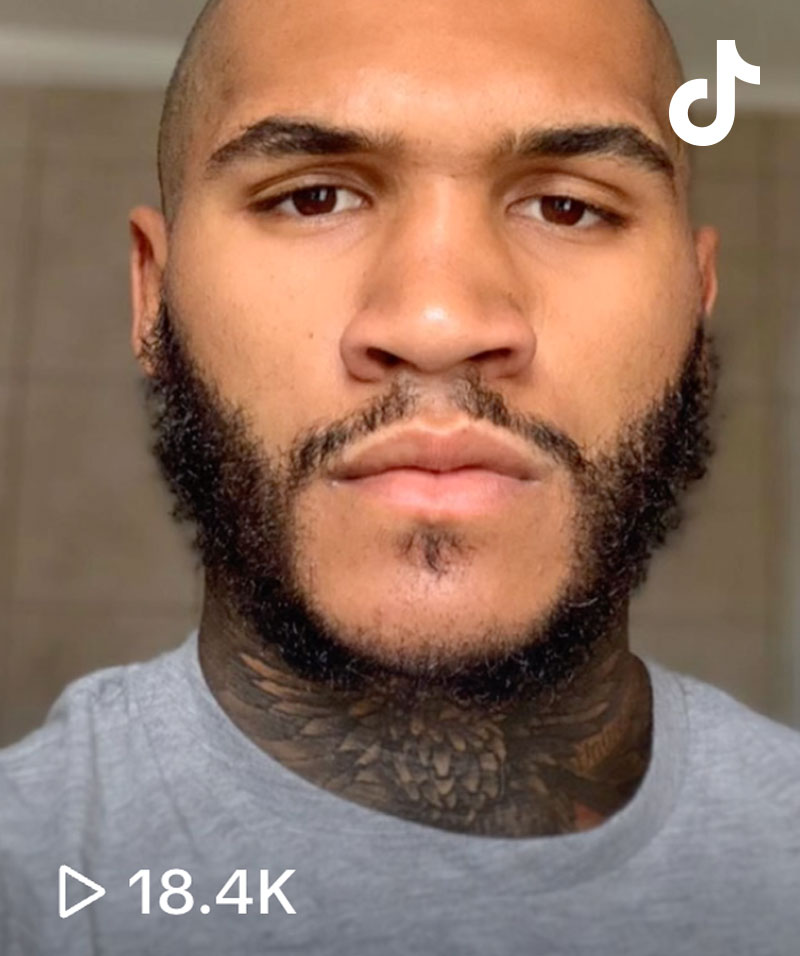 Conner Benn's Beard Transplant