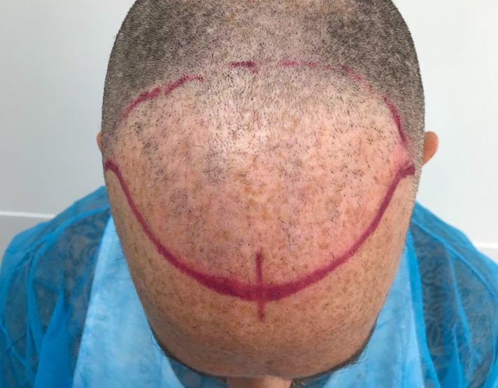 Corrective Hair Surgery - Hair Transplant - British Hair Clinic