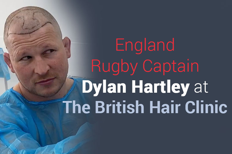 Hair Transplant - Dylan Hartley - England Rugby Star - British Hair Clinic