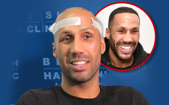 James Degale - Hair Transplant - British Hair Clinic