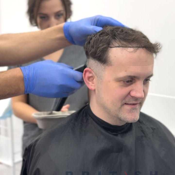 Celebrity Chef Jon Watts - Hair Surgery - British Hair Clinic