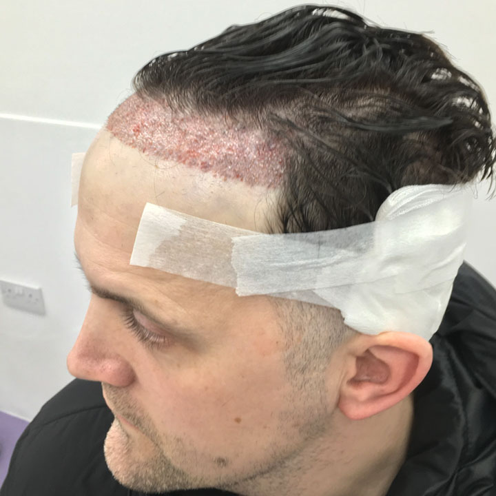Celebrity Chef Jon Watts- Hair Transplant - British Hair Clinic
