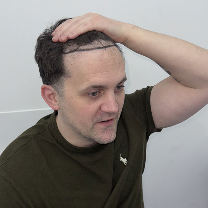 Jon Watts- Hair Surgery Celebrity Chef - British Hair Clinic