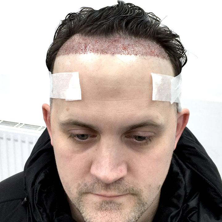 Jon Watts- Hair Transplant Celebrity Chef - British Hair Clinic