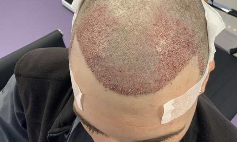Are Hair Transplants Safe? - British Hair Clinic