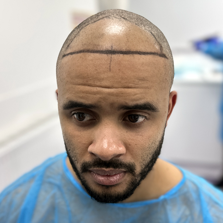 Hair Transplant Aftercare Treatment - British Hair Clinic