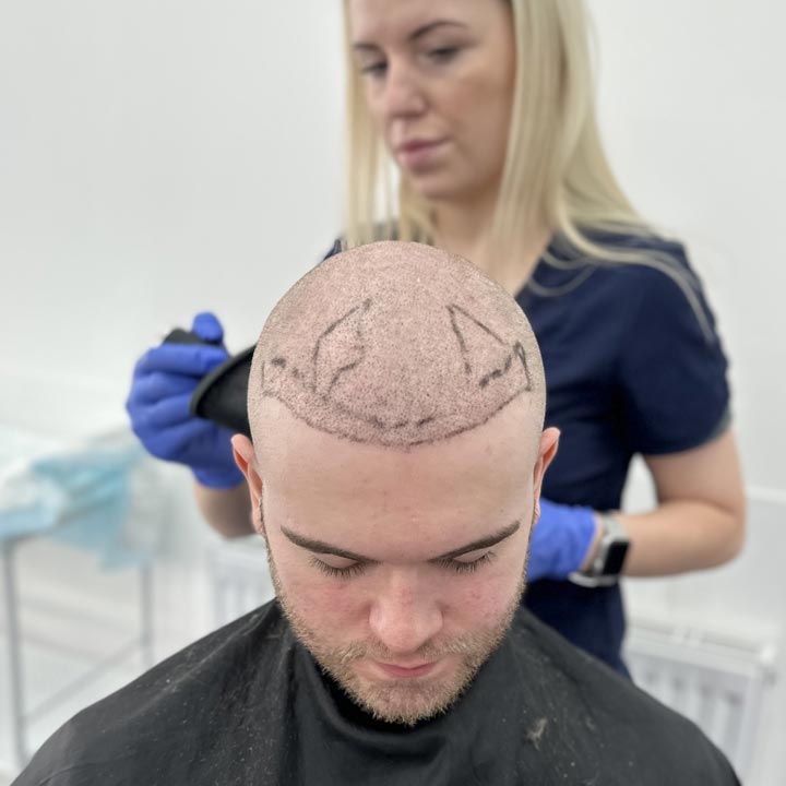 Hair Transplant Day Expectations - British Hair Clinic