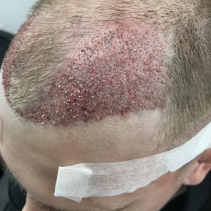 Hair Transplant Risks - British Hair Clinic