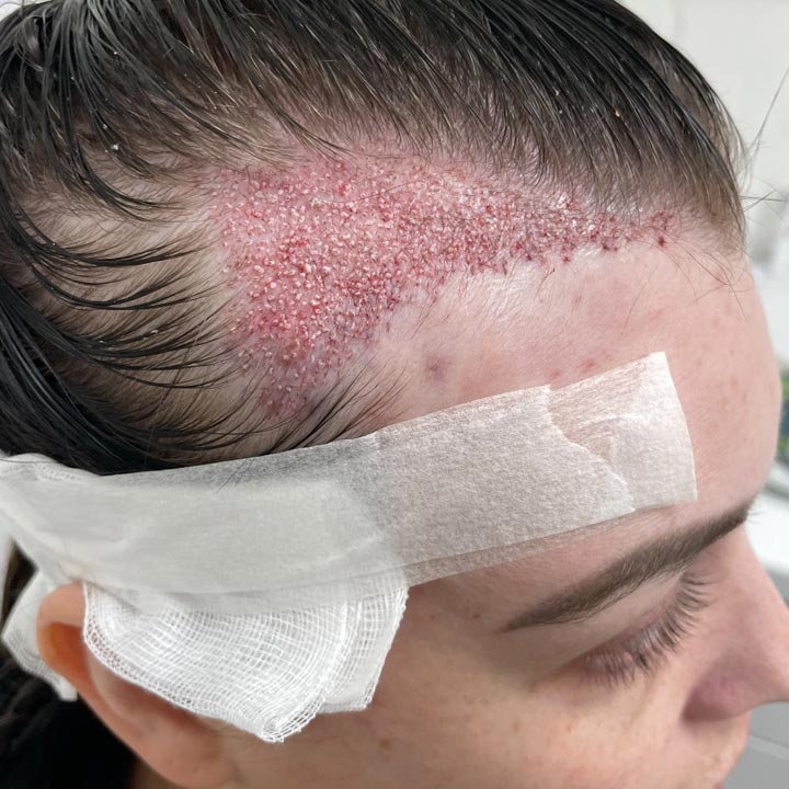 Hair Transplant Side Effects - British Hair Clinic