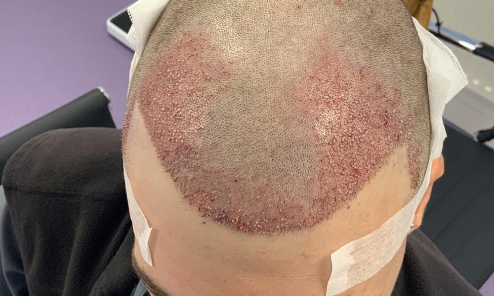 Side Effects of Hair Transplant - British Hair Clinic