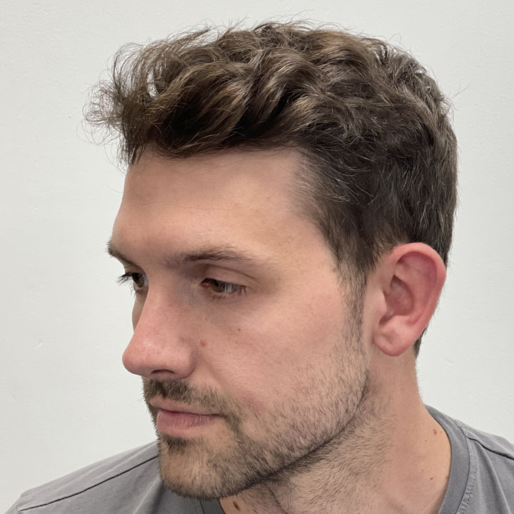 Will A Hair Transplant Result In Natural Looking Hair