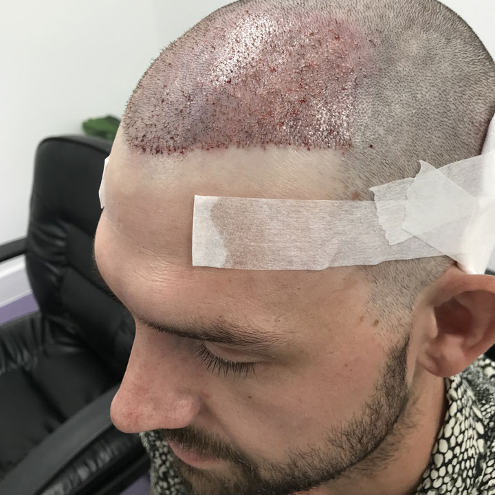 Will A Hair Transplant Result In Natural Looking Hair