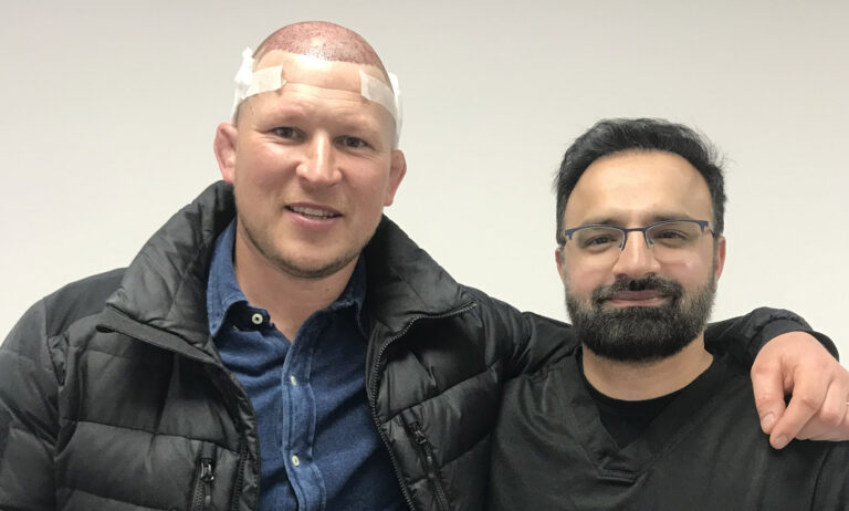 How Many Hair Transplants Can You Get Safely British Hair Clinic