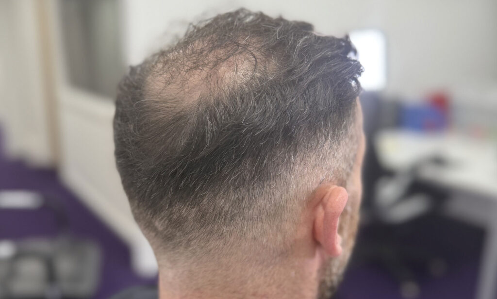 Can You Reverse Hair Miniaturisation