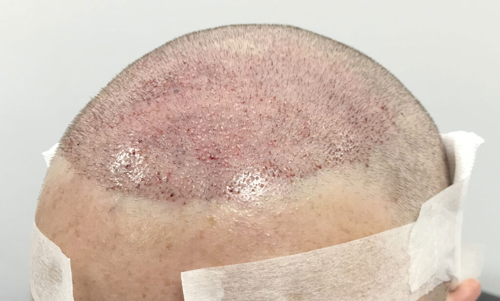 How Many Grafts Do You Need For An Fue Hair Transplant