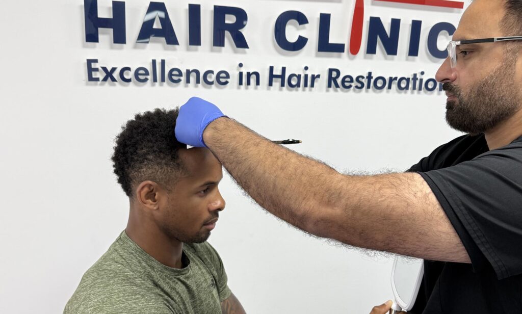 How Many Hair Transplants Can You Get Safely British Hair Clinic