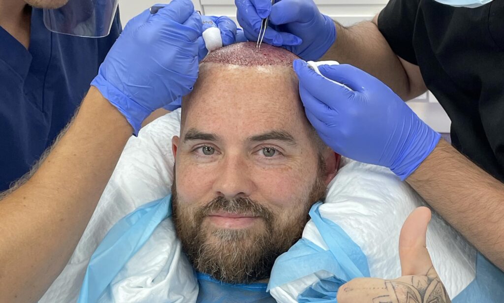 What Is Hair Miniaturisation & Can It Be Reversed