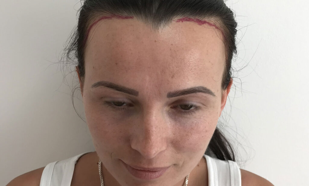 What Is The Most Common Cause Of Hair Loss In Women