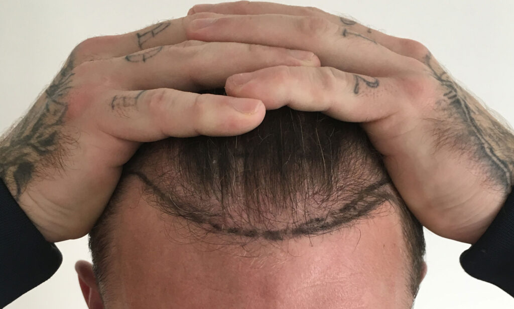 What’s The Difference Between A Receding Hairline And A Thinning Crown