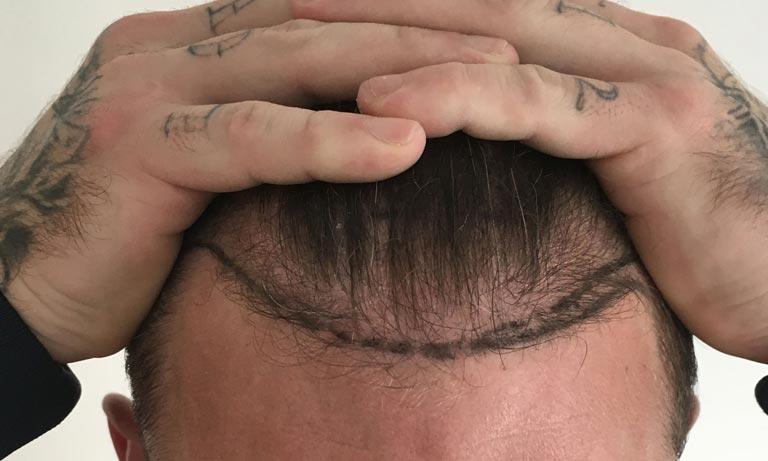 ats The Difference Between A Receding Hairline And A Thinning Crown