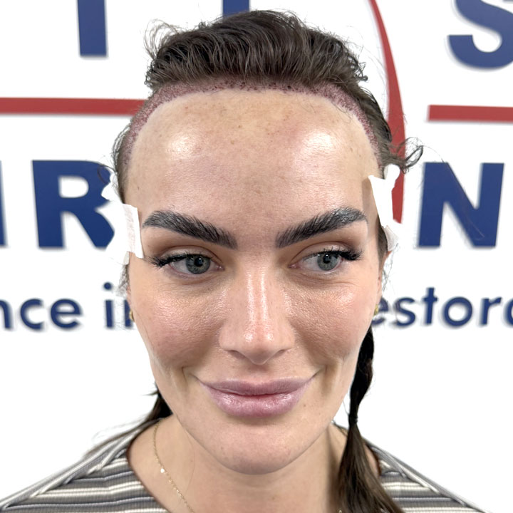 Amy Kenyon Hair Transplant - Manchester Clinic – British Hair Clinic