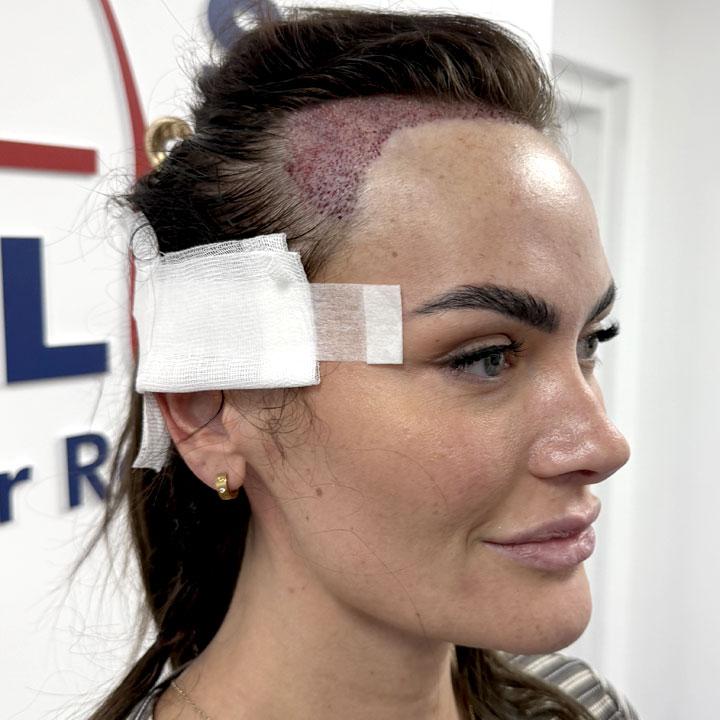 Amy Kenyon – FUE Hair Transplant Manchester – British Hair Clinic