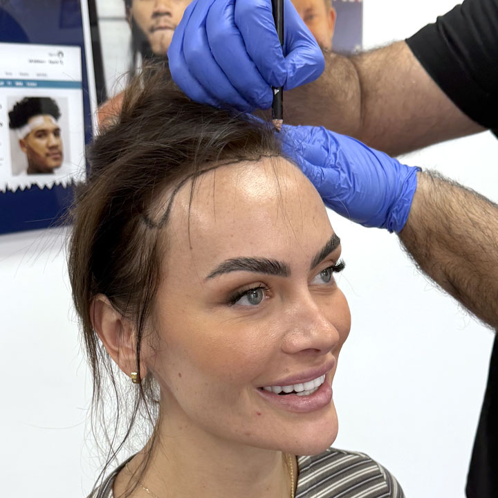 Amy Kenyon – Hair Transplant Procedure – British Hair Clinic