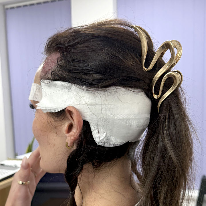 Female Hairline Transplant – UK Clinic – British Hair Clinic
