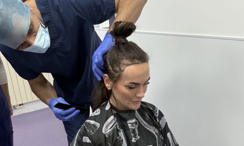 FUE Hair Transplant – Female Patient UK – British Hair Clinic