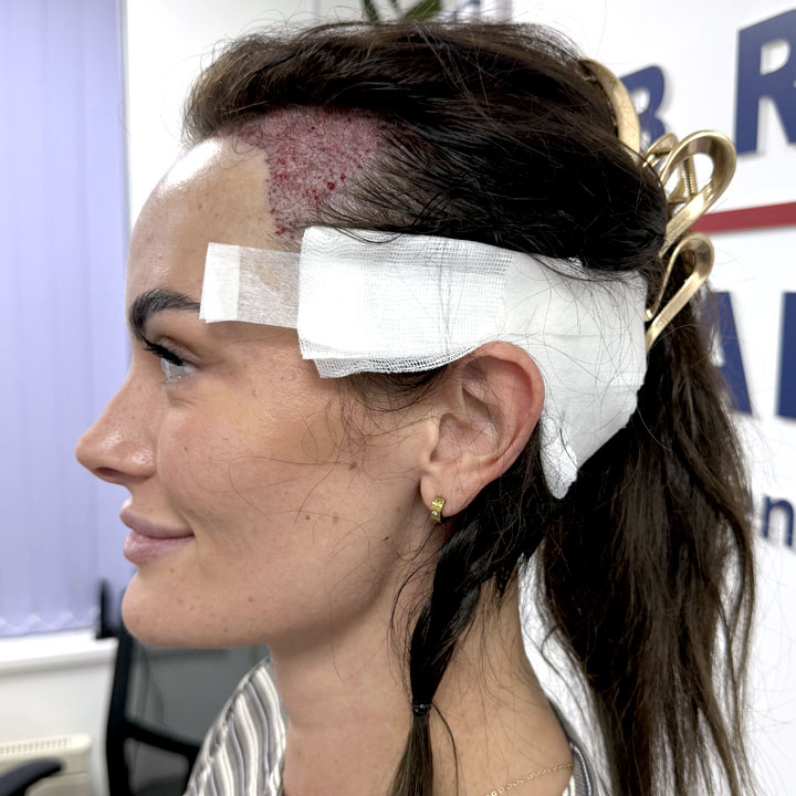 Hair Transplant Procedure for Women UK – British Hair Clinic
