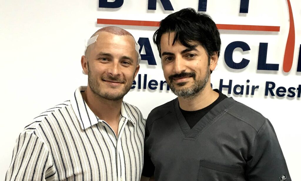 FUE Hair Transplant - Max Bowden - British Hair Clinic