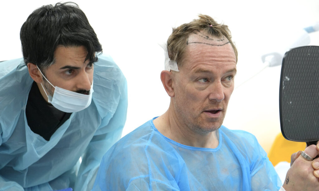 British Hair Clinic - Simon Thomas - Hair Transplant