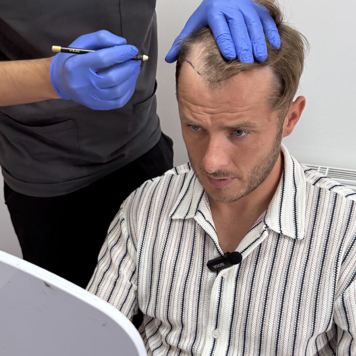 Hair Transplant - British Hair Clinic - Max Bowden