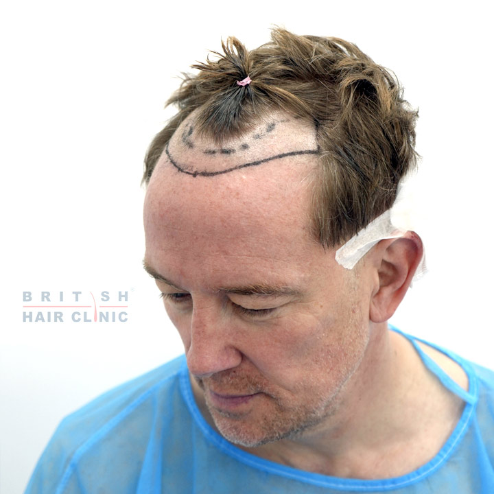 Hair Transplant - British Hair Clinic - Simon Thomas