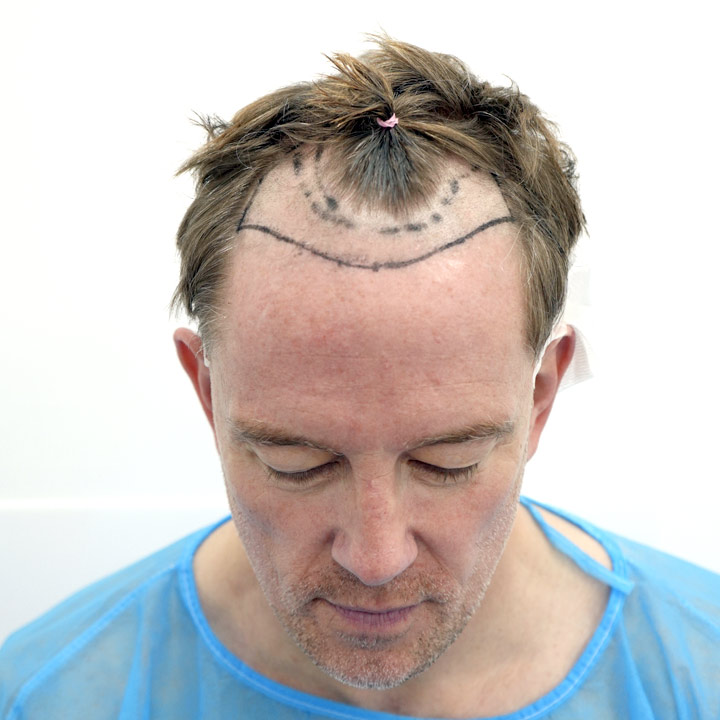 Hair Transplant - British Hair Clinic - Simon Thomas