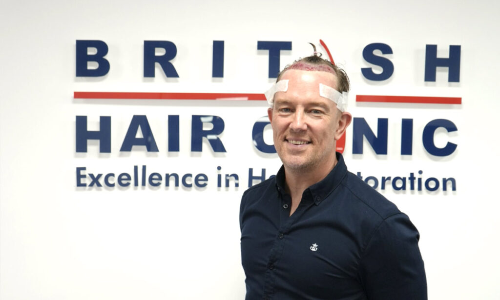 Hair Transplant - Simon Thomas - British Hair Clinic