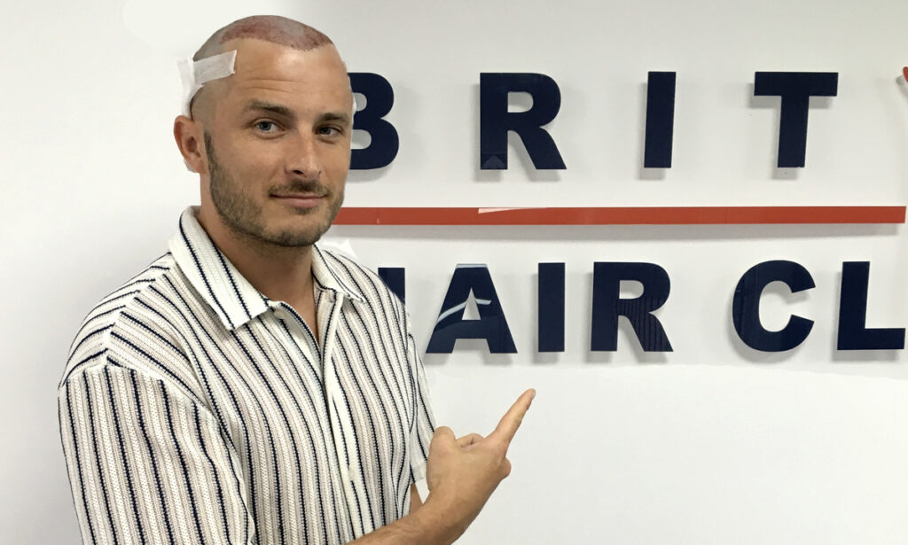 Max Bowden - British Hair Clinic - Hair Transplant