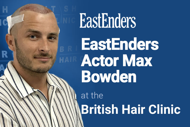 Max Bowden - Hair Transplant Procedure - British Hair Clinic