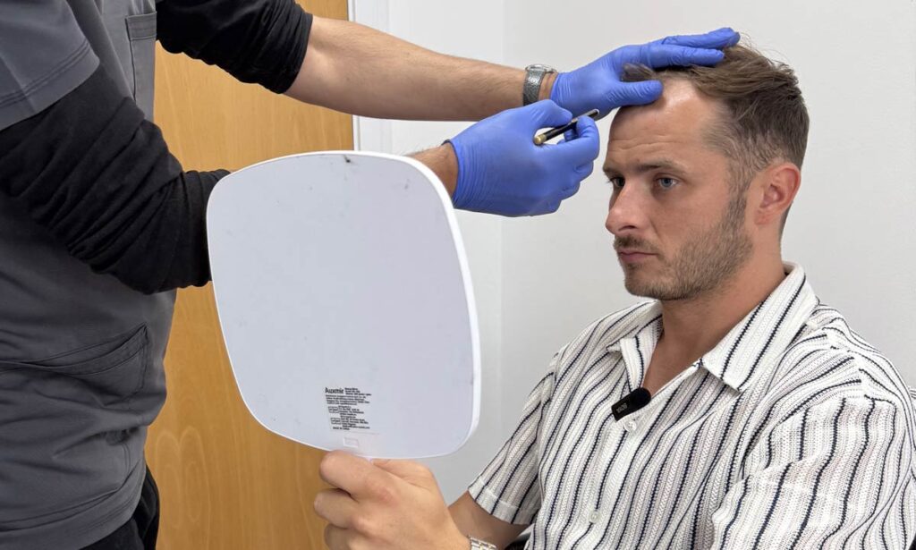 Max Bowden - Hair Transplant Results - British Hair Clinic
