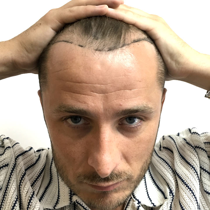 Max Bowden - Hairline Restoration - British Hair Clinic