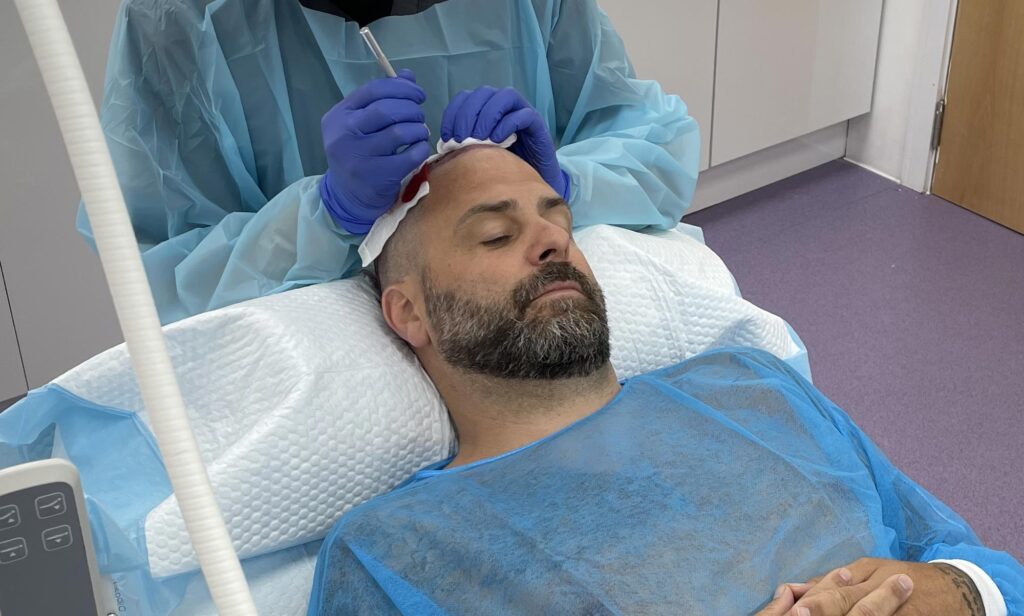 What Are The Best Options For Restoring A Receding Hairline - British Hair Clinic