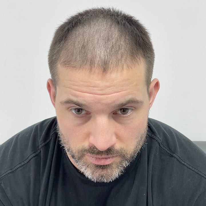 7 Tips To Improve Your Hair Transplant Success Rate