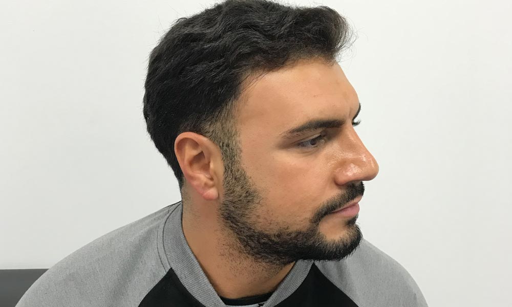 7 Tips To Improve Your Hair Transplant Success Rate
